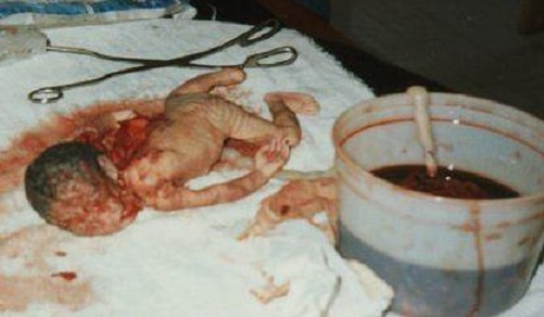 abortion-table.jpg