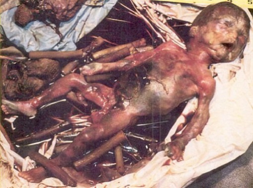 Aborted Baby Photo